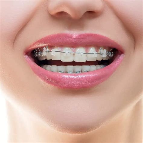 clear metal brackets|why are clear braces expensive.